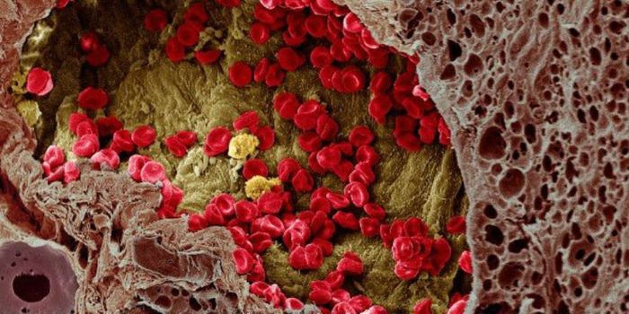 Scientists Reveal How Melanoma Spreads from Skin to Organs