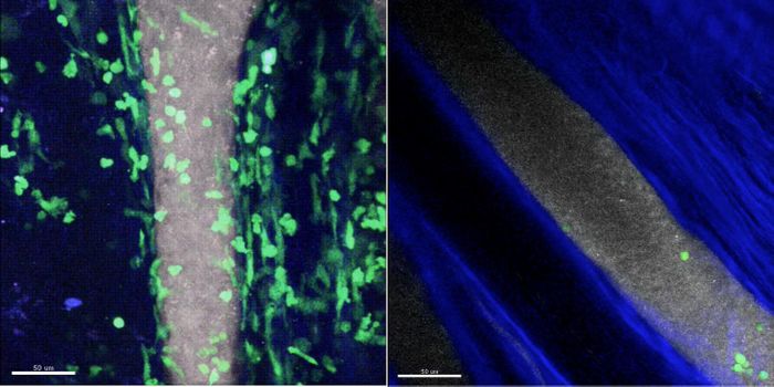 Watching Immune Cells Cause Arthritis In Real Time