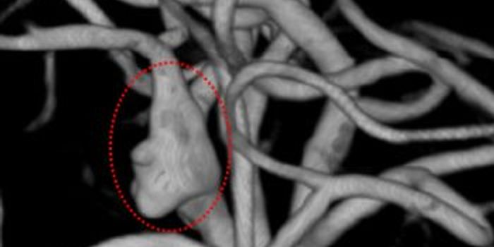 Repurposing Cancer Drug for Treating Brain Aneurysms