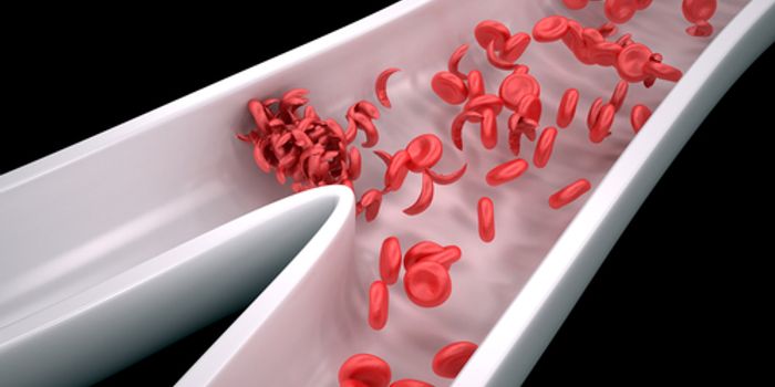 New Sickle Cell Gene Therapy Approaches