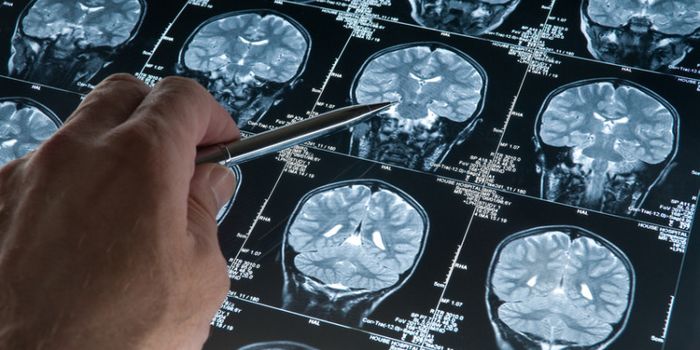 Immunotherapy: New Hope for Patients With Advanced Lung Cancer