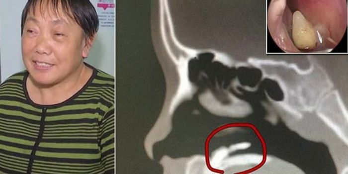 Diagnosed: Woman Had a Tooth Growing in Her Nose