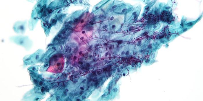 Blood Test for Candida Yeast Rapidly Improves Diagnosis Time