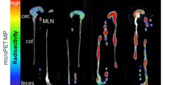 "ImmunoPET" Imaging Identifies IBD Inflammation