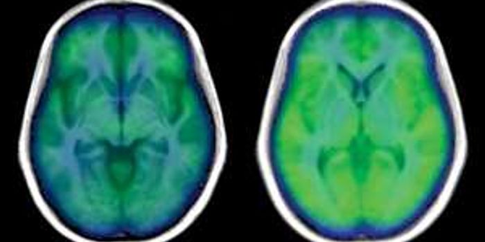 UCLA School of Nursing researchers find that sleep apnea causes weaker brain blood flow