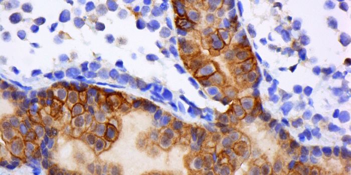 New Target for Halting Breast Cancer During Cell Division