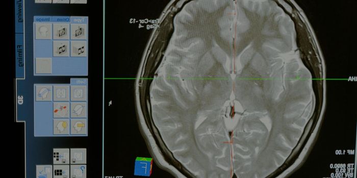 Ovary Removal Before 40 Linked to Less Brain White Matter Integrity