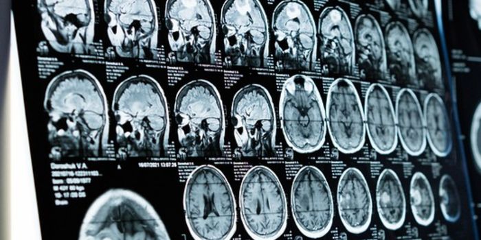 Potential Psychosis Biomarkers are Identified