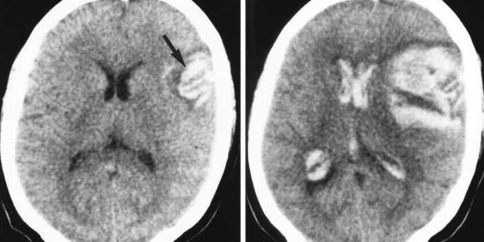 Untreated Hypertension Increases Risk for a Bleeding Stroke