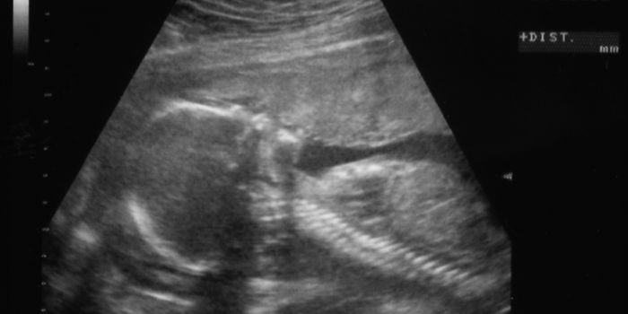 Fetal DNA Raises Risk of Mother's Pre-Eclampsia