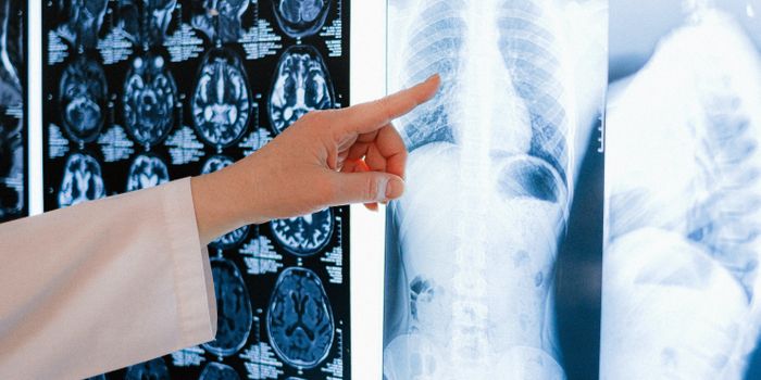 Cannabis Smokers More Likely to Develop Emphysema Compared to Cigarette Smokers