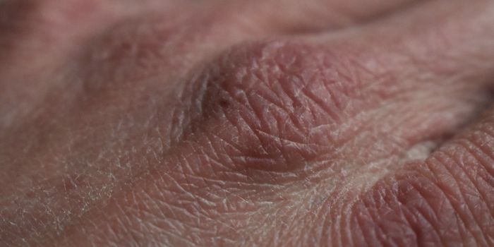 Developmental Processes Are Active in Diseased Skin Cells