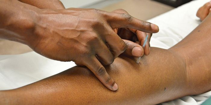 Acupuncture and vitamin D as a holistic treatment for side effects of hormone therapy in cancer patients