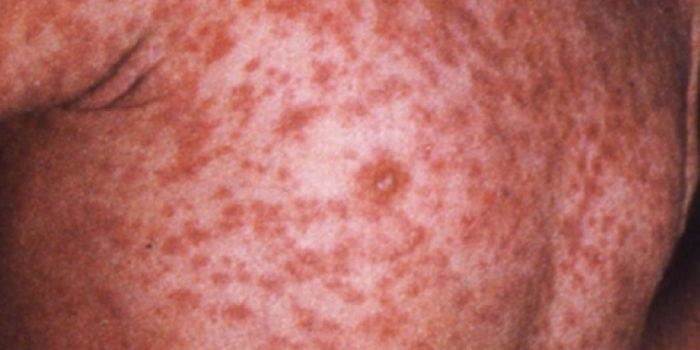 Measles Strikes Hard in Unvaccinated Communities in Minnesota