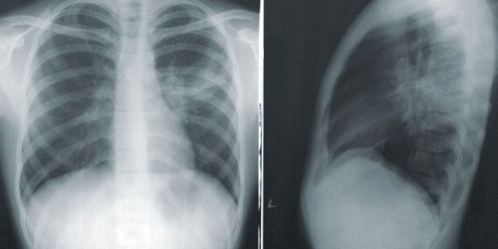Could Low-Dose Radiation Therapy Treat COVID-19?