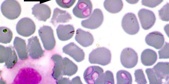 Rare Tickborne Disease "Babesiosis" Produces Strange Side Effect