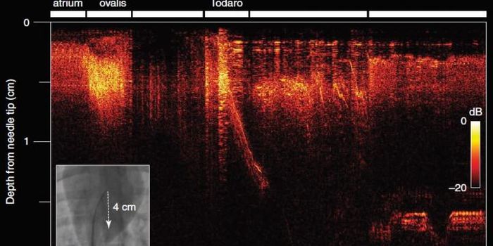 First-of-its-Kind Optical Ultrasound Imaging to Transform Heart Surgery