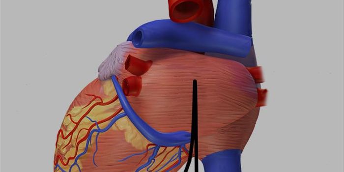 Carbon Ion Treatments Less Invasive Than Catheters