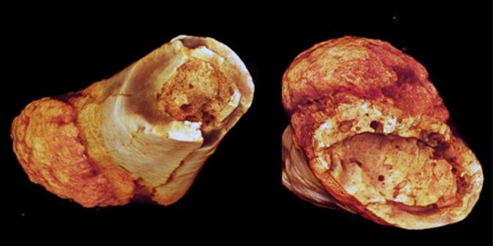 Paleo Diet Apparently Not Enough to Prevent Cancer