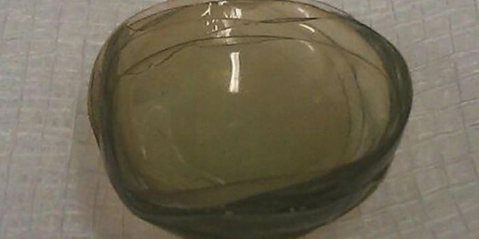 Doctors Fish 27 Contact Lenses From Woman's Eye