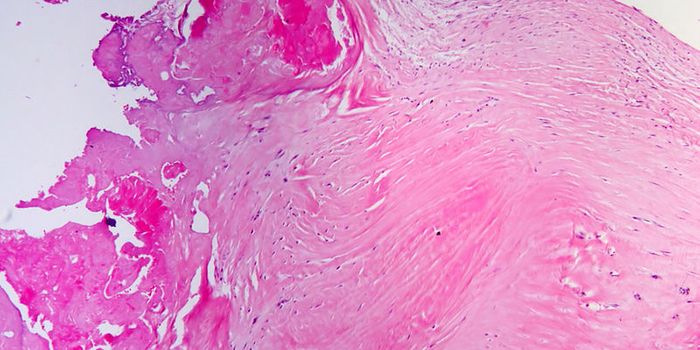Transcription Factor "Cocktail" As A Post-Heart Attack Treatment