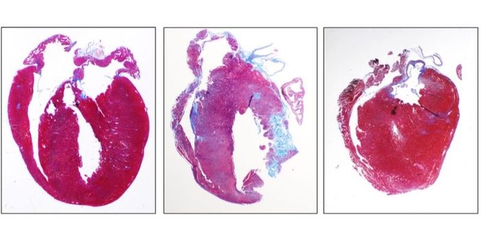 Therapeutic Targets Inflammation Associated with Genetic Heart Disease