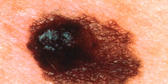 Dirt Microbe Makes Weapon That may Fight Melanoma