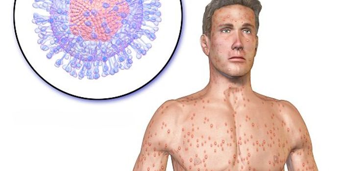 When Chickenpox Turns Deadly