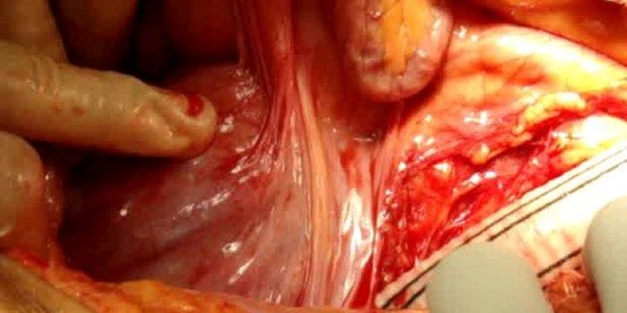 aortobifemoral graft