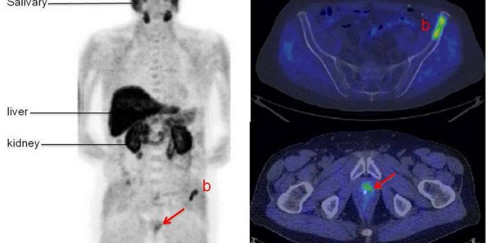 Dual-labeled PSMA Ligand Delivers a Diagnosis-Therapy Combo Punch to Prostate Cancer