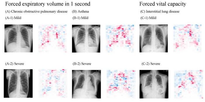 AI Model Estimates Lung Function from Chest X-Rays