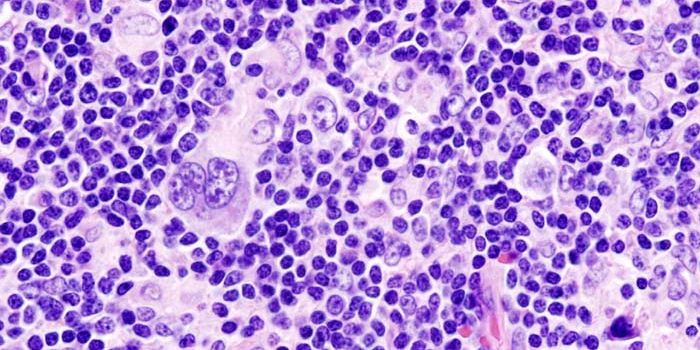 Mutations in the Immune System Increase Risk of Hodgkin Lymphoma