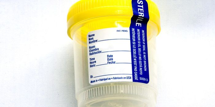 URINE TEST FINDS KIDNEY CANCER SOONER