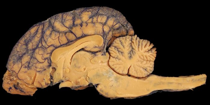 Hybrid Immune Cells from Skull Bone Marrow Suppress Brain Cancer