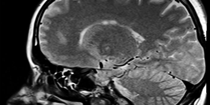 High Blood Pressure May Raise Brain Damage Risk