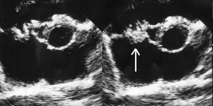 Molecular "Catch-Clamp" Mechanism Explains Infective Endocarditis