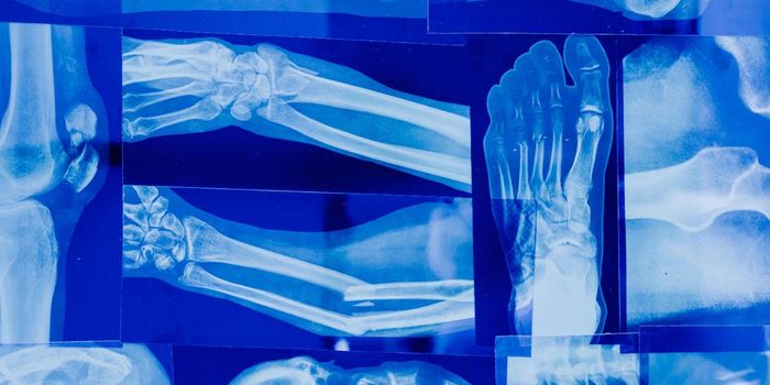 New Therapy Eliminates Bone Cancer Cells, Regenerates Bone