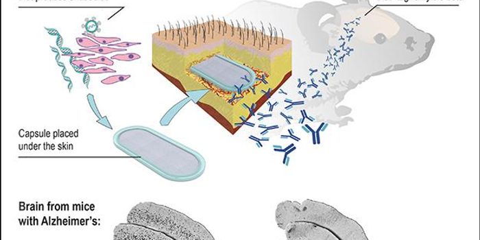 An Implant to Prevent Alzheimer's Disease