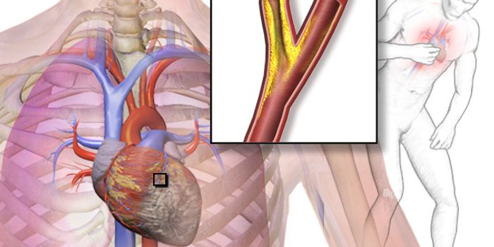 Misguided Immune Cells Treat Heart Attacks As Viral Infections