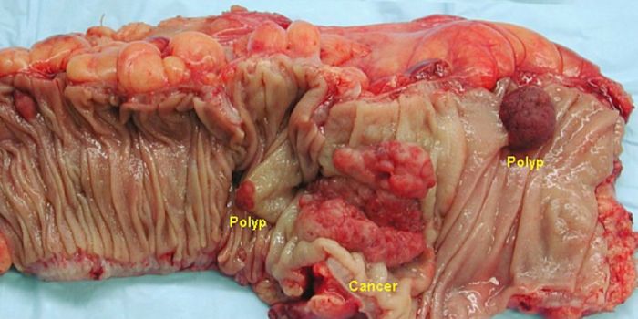 Bowel Cancer May be Tied to Prolonged Antibiotic Use