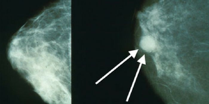 Is Breast Cancer Ever Truly Gone?