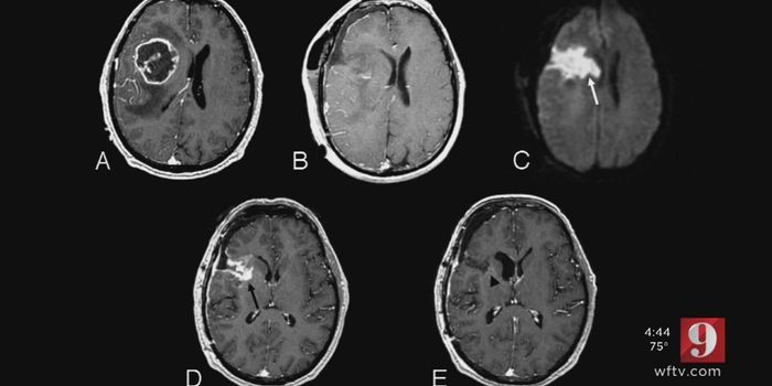Is There a Brain Cancer Cluster in Florida?
