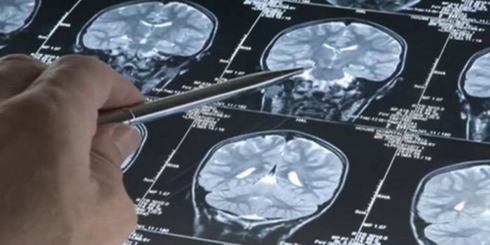 Timing in Treatment of Stroke