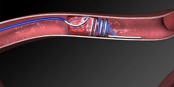 A Device to Treat Stroke