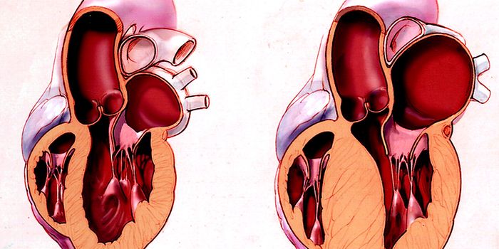 Specific Anesthesia Treatment Helps Stress-Induced Cardiomyopathy Patients