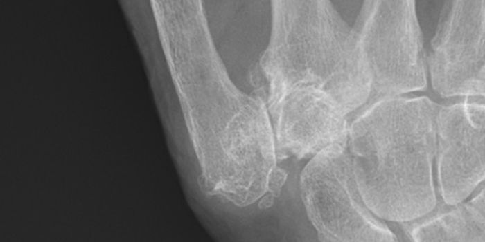 New Osteoarthritis Genes Point to Therapeutic Targets