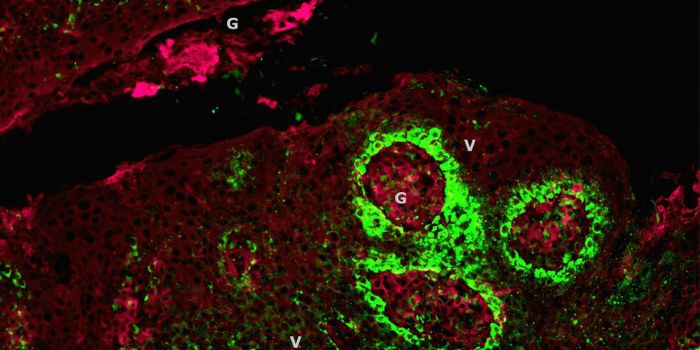 Is HPV Hiding in Your Tonsils?