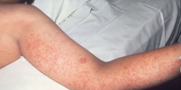 Measles Outbreaks Strike Samoa, DRC