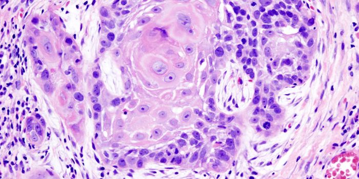 Metastatic Tumors Outsmart the Immune System