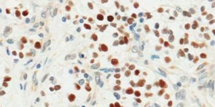 Therapeutic Target For Kidney Cancers